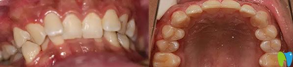 登特口腔牙齒矯正前后效果對比圖