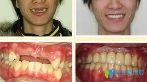 長(zhǎng)沙雅美口腔李偉即可種植牙效果圖