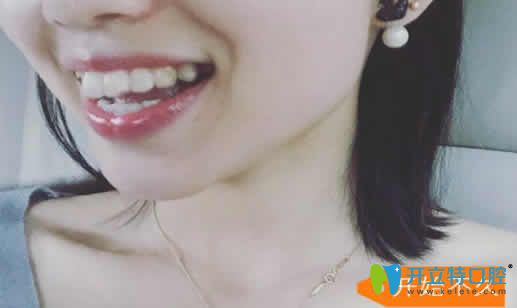 長(zhǎng)沙雅美口腔劉景醫(yī)生剛開(kāi)始給我做隱形牙齒矯正照片 長(zhǎng)沙雅美口腔劉景醫(yī)生剛開(kāi)始給我做隱形牙齒矯正照片