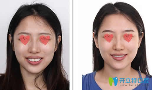 我在長(zhǎng)沙雅美口腔做隱形牙齒矯正前后效果對(duì)比圖 我在長(zhǎng)沙雅美口腔做隱形牙齒矯正前后效果對(duì)比圖