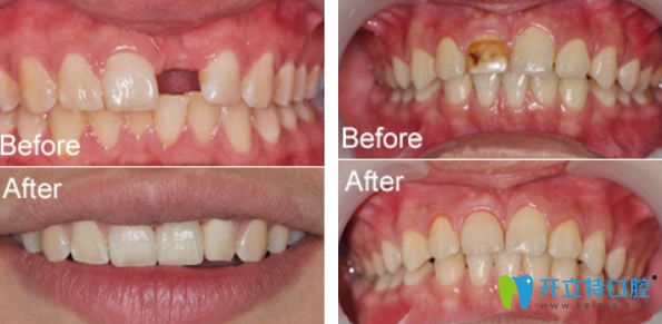 維樂口腔種植牙及色素牙修復(fù)效果對比圖