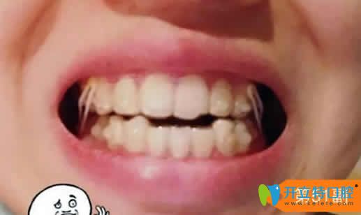 我找長(zhǎng)沙雅美口腔劉景做隱形牙齒矯正第51副牙套照片 我找長(zhǎng)沙雅美口腔劉景做隱形牙齒矯正第51副牙套照片