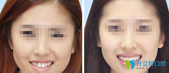 長沙牙大夫口腔牙齒矯正案例效果圖 長沙牙大夫口腔牙齒矯正案例效果圖