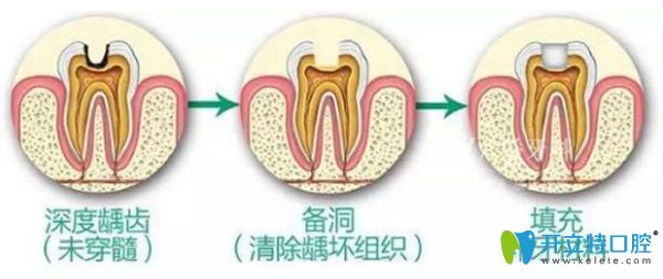 在上海拜博補(bǔ)牙多少錢 補(bǔ)牙用什么材料好/價(jià)格上相差多嗎