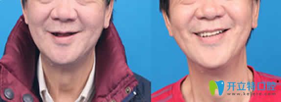 牙大夫口腔種植牙前后效果對比圖 牙大夫口腔種植牙前后效果對比圖