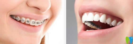 請(qǐng)問(wèn)牙齒矯正年齡有限制嗎？解惑牙齒矯正幾歲合適