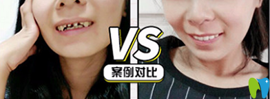 牙博士口腔怎么樣？看牙齒全瓷冠修復案例前后對比圖