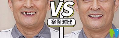 牙博士口腔好嗎？看牙博士種牙案例效果