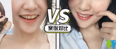 青島牙博士口腔好不好？看牙齒美白真人案例來驗證