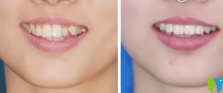 通過顧客評(píng)價(jià)來看深圳美萊口腔韓旭院長做隱形矯正怎么樣