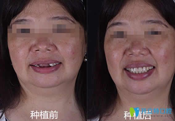 無錫通善口腔王杏松多顆牙種植案例效果圖