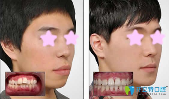26歲牙齒矯正前后效果對比圖