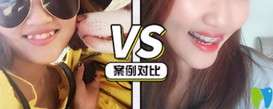 青島牙博士口腔靠譜嗎？牙博士口腔半隱形牙齒矯正案例來證明