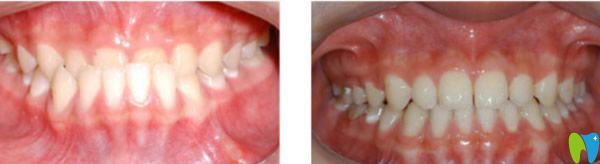 廣州矯正牙齒要多少錢 拜博/德系/壹加壹口腔的價(jià)格都不同