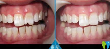 瓜子牙修復(fù)前后效果對(duì)比圖