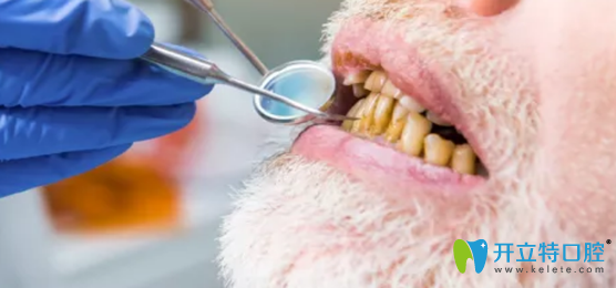 烤瓷牙壽命是多久呢