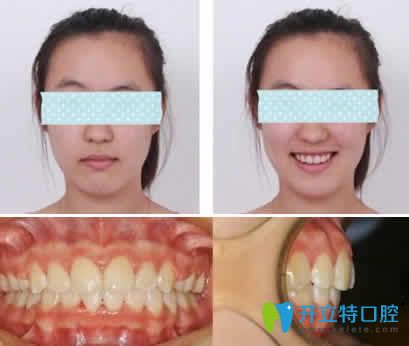 我在無錫通善口腔做隱形齙牙矯正一年后效果