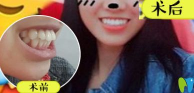 王云隱形牙齒矯正案例前后效果對(duì)比圖