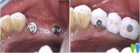 北京齒泰華口腔多顆牙種植效果圖