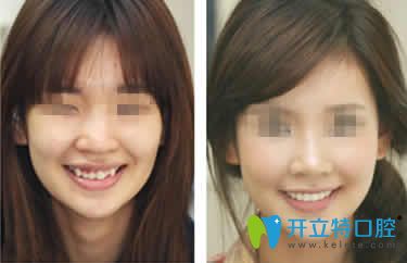 無(wú)錫通善口腔趙超醫(yī)生隱形牙齒矯正案例效果圖 無(wú)錫通善口腔趙超醫(yī)生隱形牙齒矯正案例效果圖