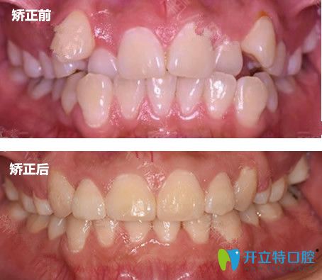 找青島牙博士口腔王蕓做女生虎牙矯正707天前后變化對比圖