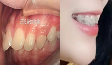 來(lái)看我在沈陽(yáng)歡樂(lè)口腔戴半隱形牙套前后效果圖 歷時(shí)665天