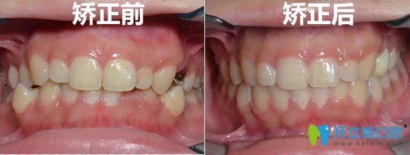 在廈門拜博口腔沒(méi)拔牙正畸前后對(duì)比照