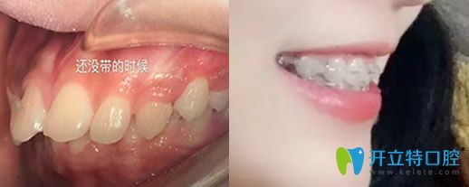 26歲牙齒正畸前后對(duì)比圖