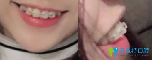 沈陽(yáng)歡樂(lè)口腔牙齒正畸剛戴牙套兩個(gè)時(shí)候的照片