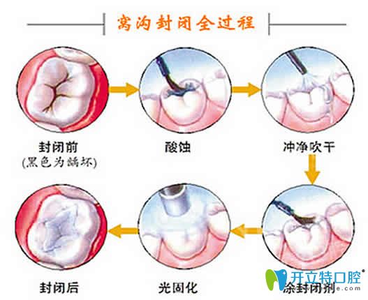 兒童牙齒窩溝封閉多少錢?分享全新的窩溝封閉價格及利弊