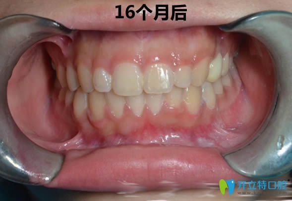 沒(méi)拔牙矯正16個(gè)月后的正畸效果