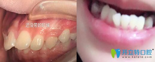 在沈陽(yáng)歡樂(lè)口腔做牙齒正畸前的樣子