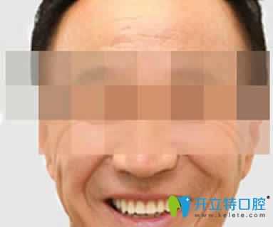 無錫通善口腔王杏松即刻種植牙案例效果圖