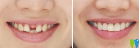 北京齒泰華口腔劉洪飛醫(yī)師單顆牙種植效果圖