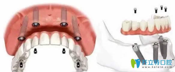 解析全口重建需要多少錢？?jī)r(jià)格和假牙為什么相差這么大