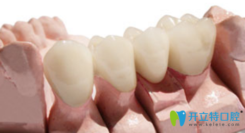 納米烤瓷牙是金屬牙嗎？納米烤瓷牙多少錢？