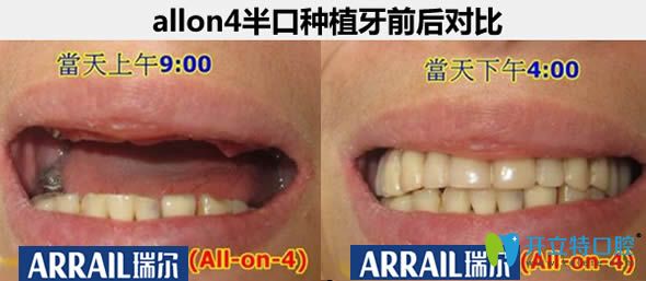 杭州瑞爾口腔allon4種植牙真實(shí)案例