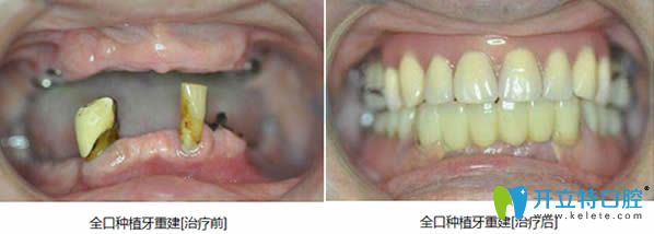 泉州維樂全口種植牙真實案例