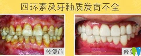 維樂口腔牙齒瓷貼面治療前后對比案例