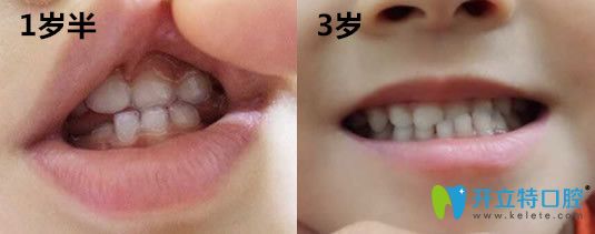3歲孩子在哈爾濱大象口腔做牙齒地包天矯正前圖片