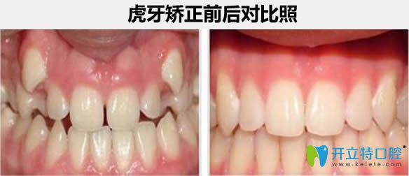 杭州瑞爾齒科成人虎牙矯正案例及前后對(duì)比照