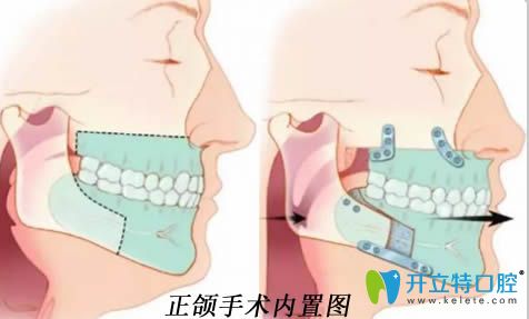解答正頜手術(shù)的費(fèi)用是多少錢(qián)和什么情況需要做口腔正頜