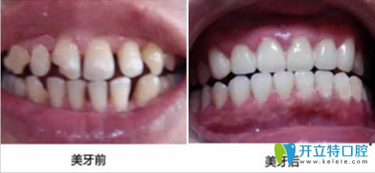 廣州置略馬瀧齒科鄒波全瓷牙6顆修復真人照片