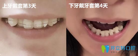 在<!--<i data=20240703-sp></i>-->口腔做牙齒矯正剛戴牙套時(shí)樣子