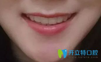 結(jié)束正畸，戴保持器圖片