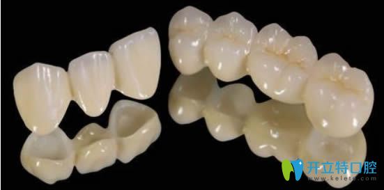 全瓷牙的價格一般多少錢