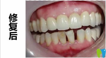 在廣州馬瀧齒科做完二氧化鋯全瓷牙修復(fù)后的效果