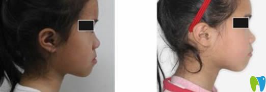 廣州瑞泰口腔<!--<i data=20240703-sp></i>-->醫(yī)生兒童地包天牙齒矯正案例及前后對比照