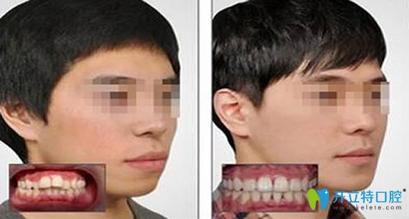 牙齒矯正會(huì)改變臉型嗎
