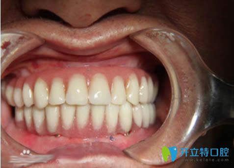 全口種植牙后即刻效果